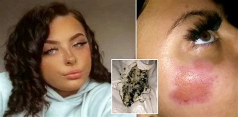 charger exploding girl|Teen left with facial burns after phone charger catches。